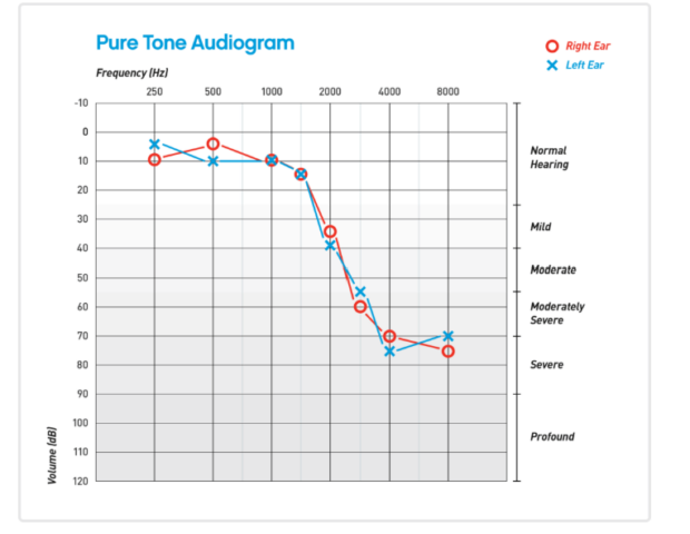 Severe High Frequency Hearing loss audiogram